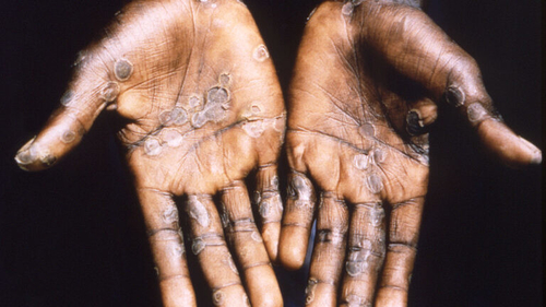 Latest company news about WHO, Monkeypox salgınının küresel halk sağlığı için 'orta risk' oluşturduğunu söylüyor